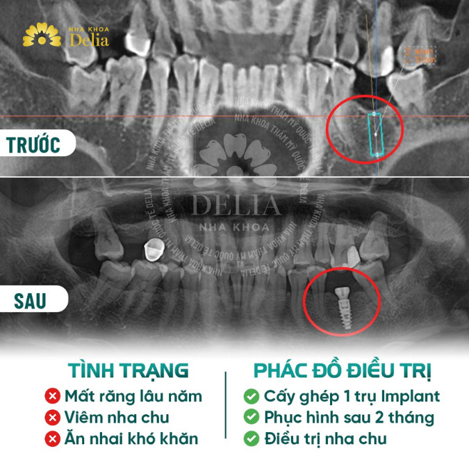 Phác đồ điều trị cho cchị Dung bao gồm cấy ghép 1 trụ Implant, điều trị nha chu