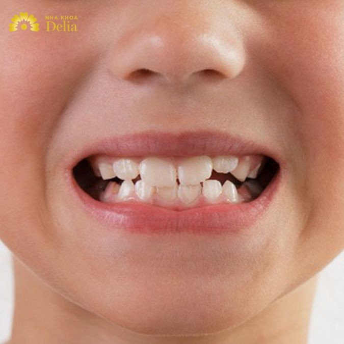 Đa số người sở hữu dáng răng chuột thường khiến người nhìn lầm tưởng là bị móm