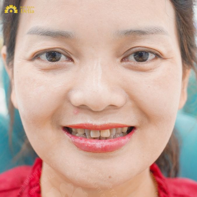 Với những trường hợp viêm nhiễm nặng, bác sĩ nha khoa sẽ cần can thiệp