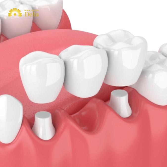 Cầu răng sứ cho người già cần mài nhỏ 2 răng thật bên cạnh để làm trụ cho cầu