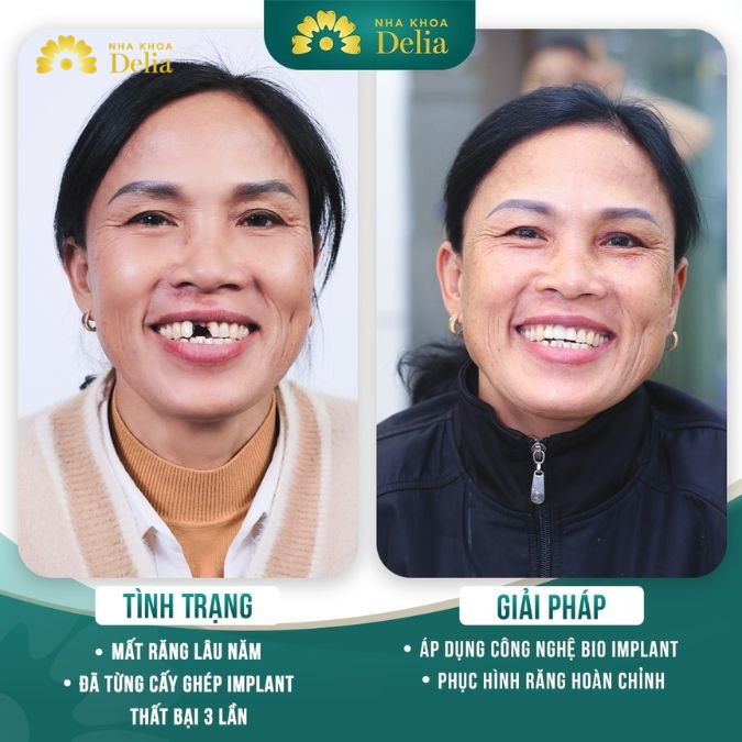 Răng giả tháo lắp không phù hợp với mọi trường hợp răng miệng