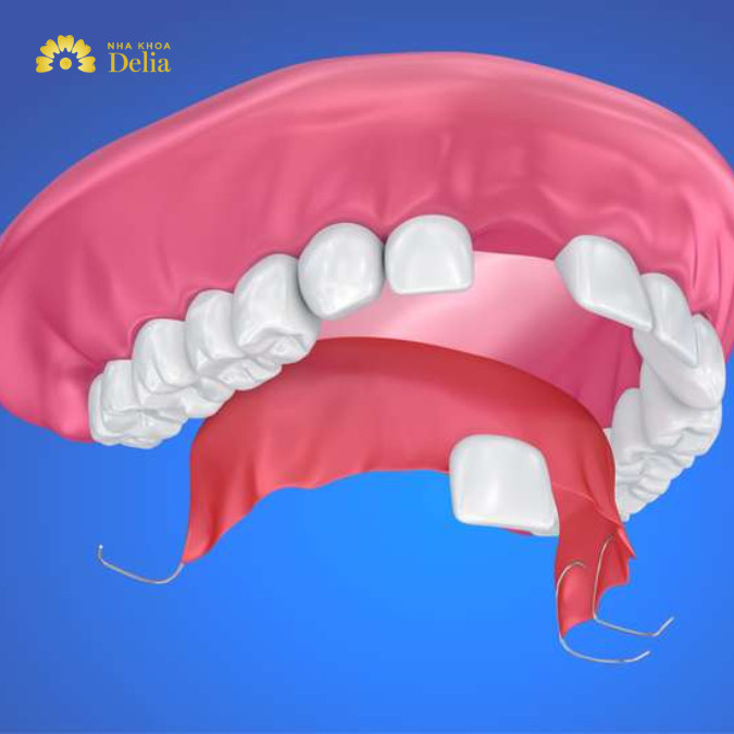 Ưu điểm của phương pháp làm răng giả tháo lắp một chiếc: khôi phục chức năng ăn nhai khá ổn