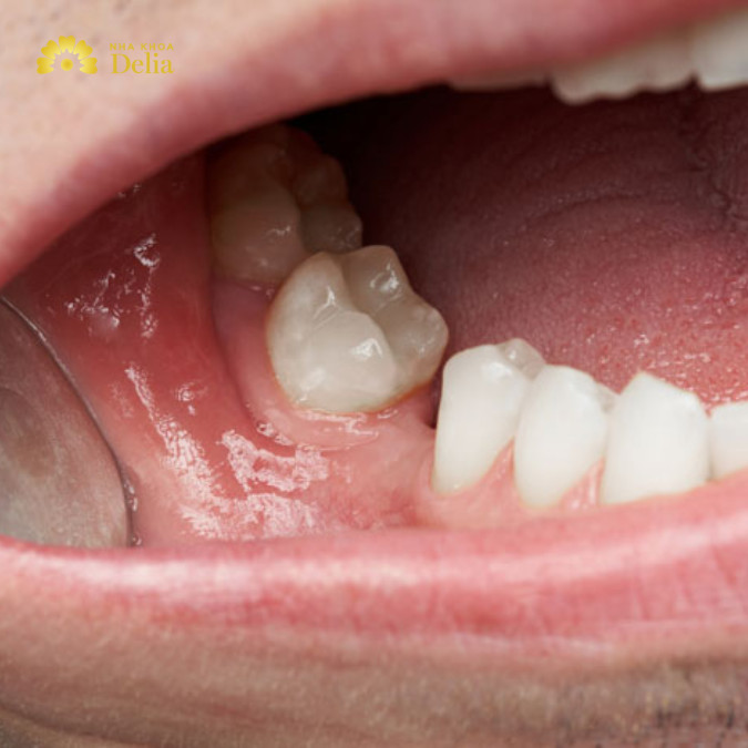 Răng giả tháo lắp 1 chiếc không ngăn ngừa tiêu xương hàm