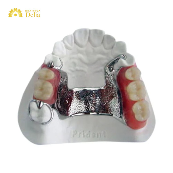 Răng giả tháo lắp bằng khung kim loại giúp cả hàm răng ổn định và chắc chắn hơn