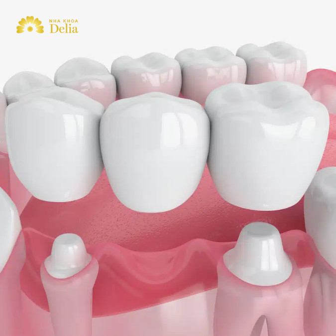Cầu răng sứ là một giải pháp phục hình răng thẩm mỹ và chức năng của răng