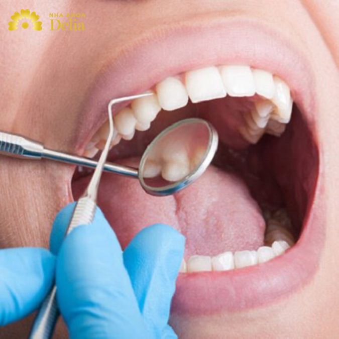 Để bảo vệ sức khỏe răng miệng, bạn cần vệ sinh răng miệng định kỳ 3 đến 6 tháng/lần