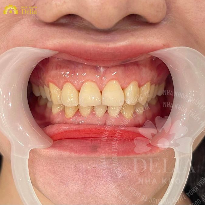 Khi răng bị sâu, màu sắc của răng cũng sẽ không còn được trắng sáng