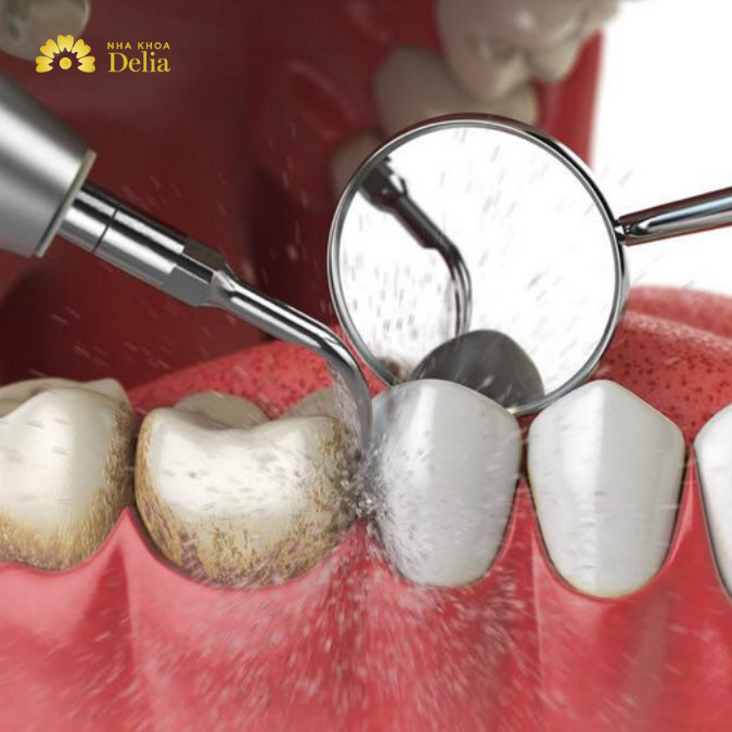 Điều trị sưng mộng răng tại nha khoa với việc cạo vôi răng