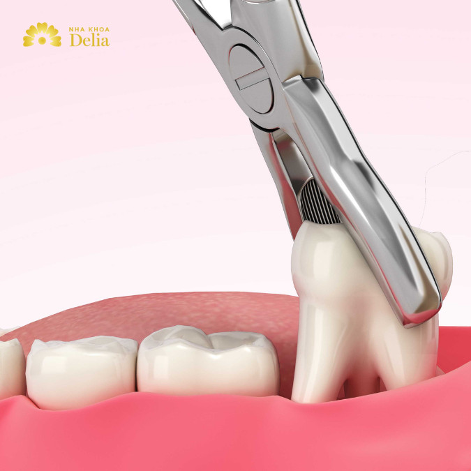 Trường hợp sưng mộng răng do răng khôn mọc lệch, bác sĩ sẽ chỉ định nhổ răng khôn để điều trị