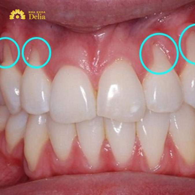 Viêm nướu hoặc viêm nha chu là các bệnh lý răng miệng phổ biến gây ra tình trạng sưng mộng răng.