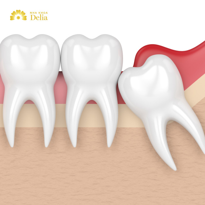Răng khôn mọc lệch hoặc mọc ngầm gây áp lực lên các răng lân cận và nướu, dẫn đến sưng và viêm