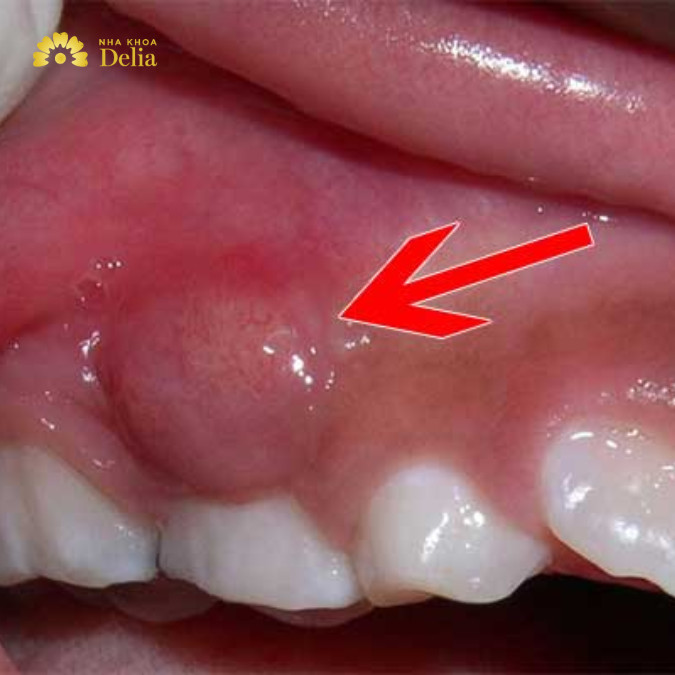 Chấn thương vùng miệng do tai nạn, va đập mạnh hoặc các thủ thuật nha khoa không đúng kỹ thuật cũng có thể gây sưng mộng răng.