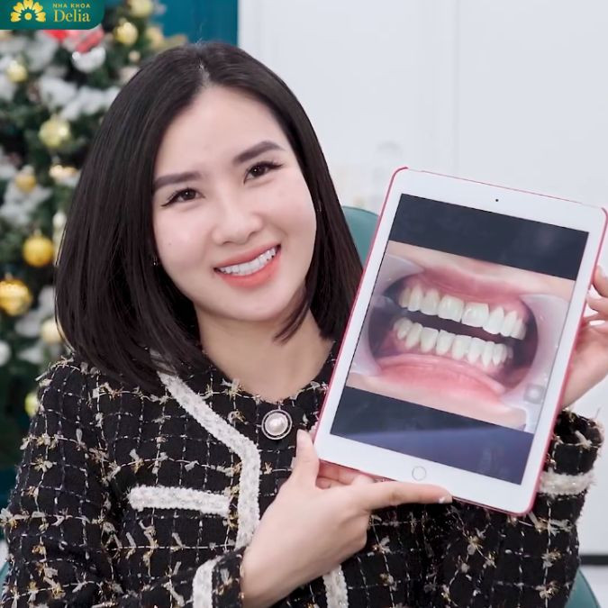 Với hình thể và màu sắc răng không đẹp, bác sĩ tại Delia đã tư vấn chị bọc răng sứ Ceramill