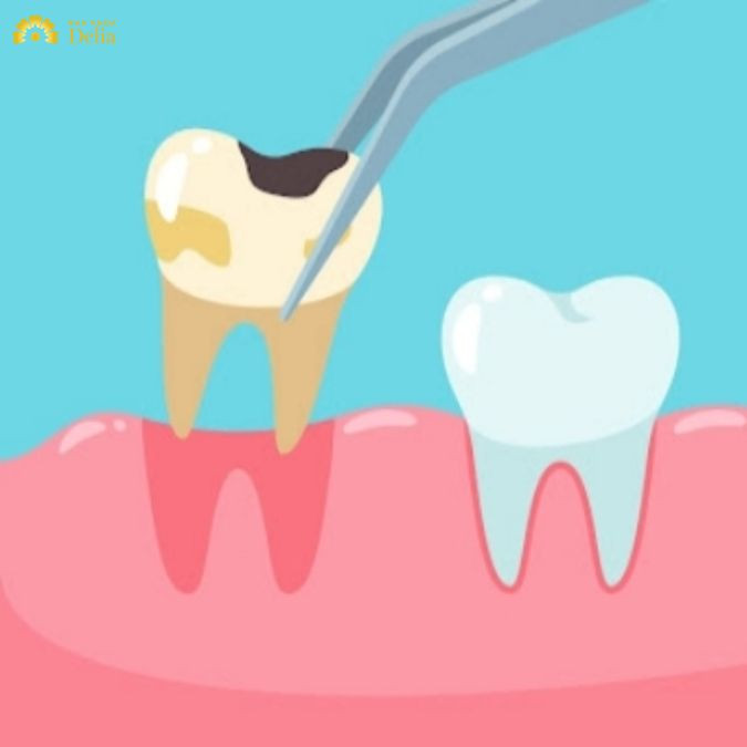 Trong trường hợp răng bị hư hỏng nặng bác sĩ có thể phải nhổ bỏ răng