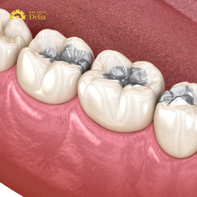 Trám răng Amalgam là kỹ thuật sử dụng một loại hợp kim gọi là Amalgam để lấp đầy các lỗ sâu, mẻ hoặc hỏng trên răng.