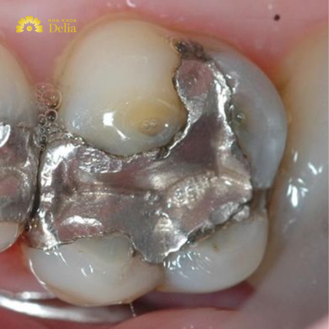 Quy trình trám răng bằng Amalgam tương đối đơn giản và nhanh chóng.
