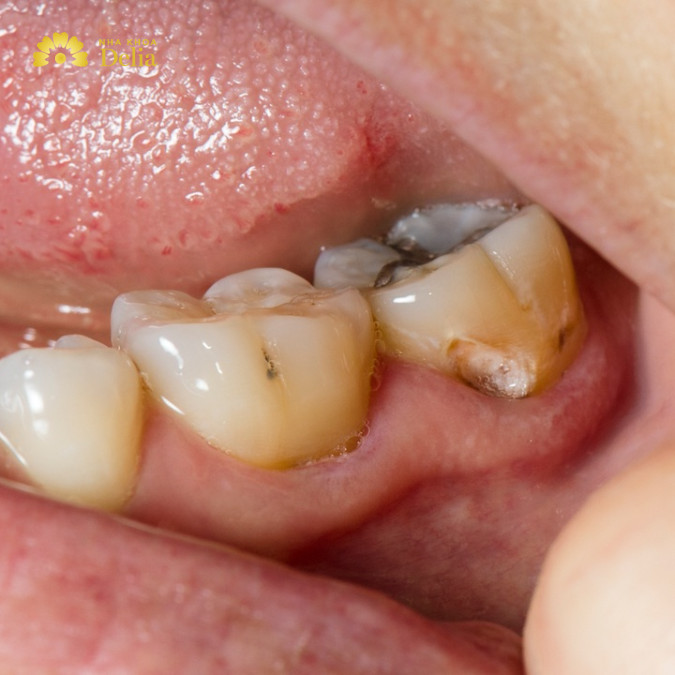 Vệ sinh cầu răng sứ không đúng cách rất dễ bị viêm nhiễm chân răng