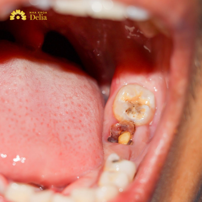 Vi khuẩn Streptococcus mutans là thủ phạm chính gây tình trạng đau sâu răng
