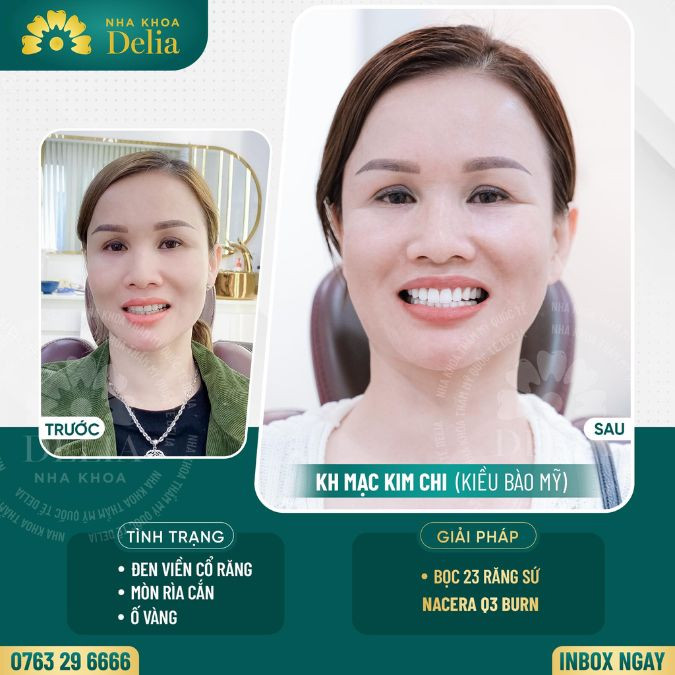 Răng sứ Nacera Pearl Q3 Burn