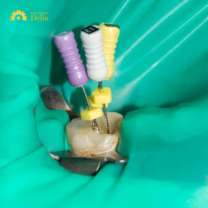 Nha sĩ sẽ tạo một lỗ nhỏ trên bề mặt răng để tiếp cận phần tủy bên trong.