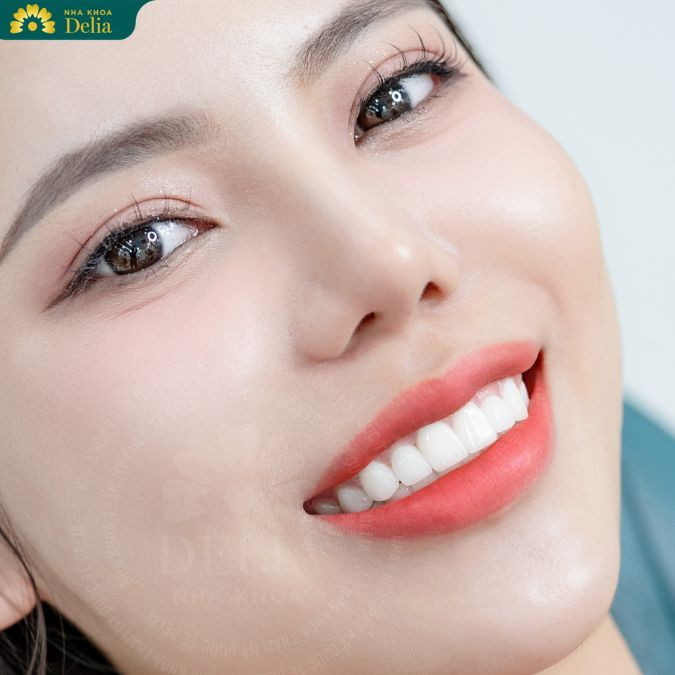 Công nghệ dán sứ Veneer siêu mỏng được đánh giá là bước tiến mới trong ngành nha khoa thẩm mỹ
