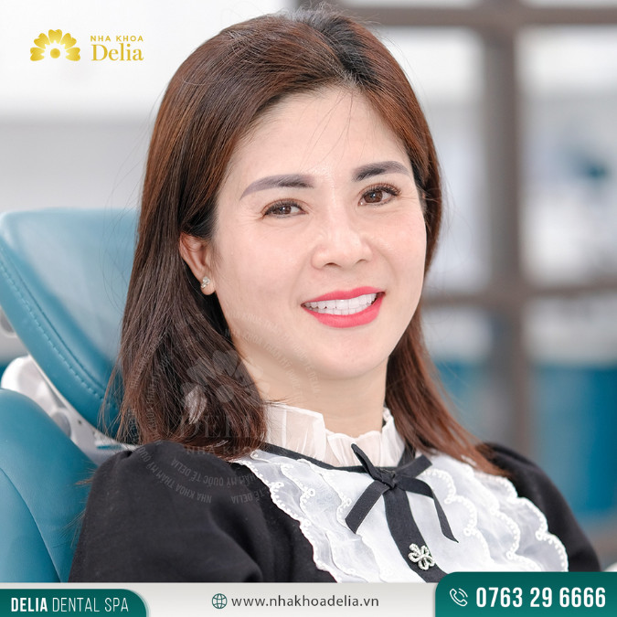 Hình ảnh mới nhất của chị Phương Thoa sau khi trồng răng Implant với trụ SIC Thụy SĨ