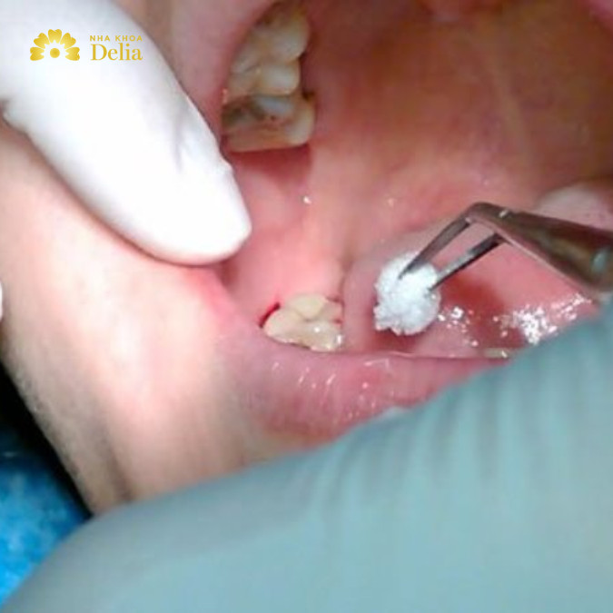 Miếng gạc trắng cần phải cắn chặt sau khi nhổ răng sâu