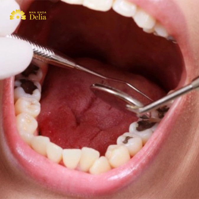 Nhổ răng sâu sẽ không bao giờ mọc lại nếu răng đó là răng vĩnh viễn.