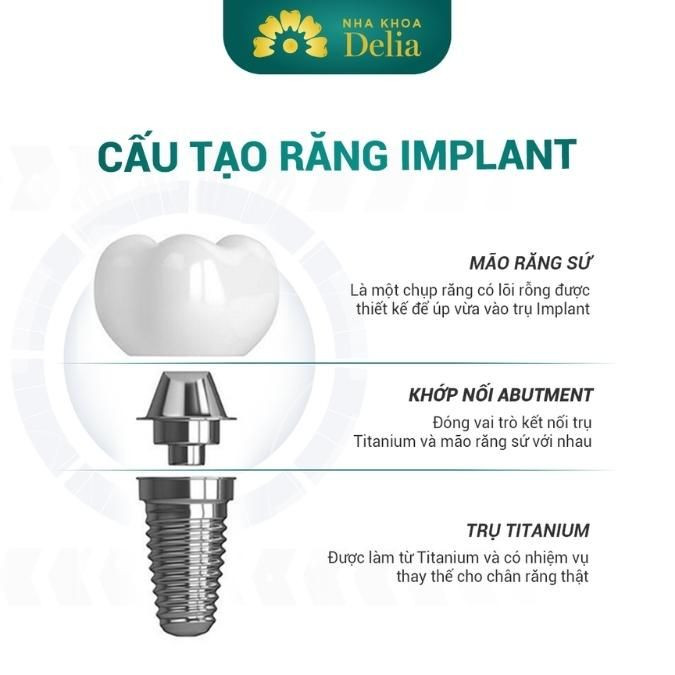 Cấu tạo răng Implant gồm mão răng sứ, khớp nối abutment và trụ Implant
