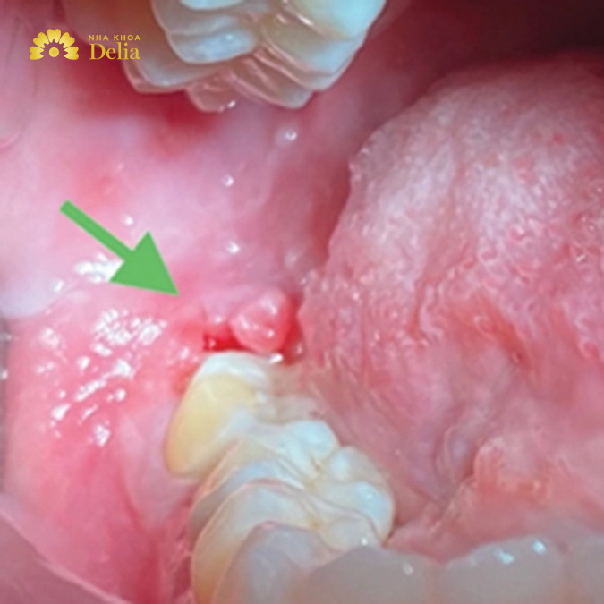 Một số trường hợp có thể gặp phải tình trạng chảy máu không ngừng sau khi nhổ răng.