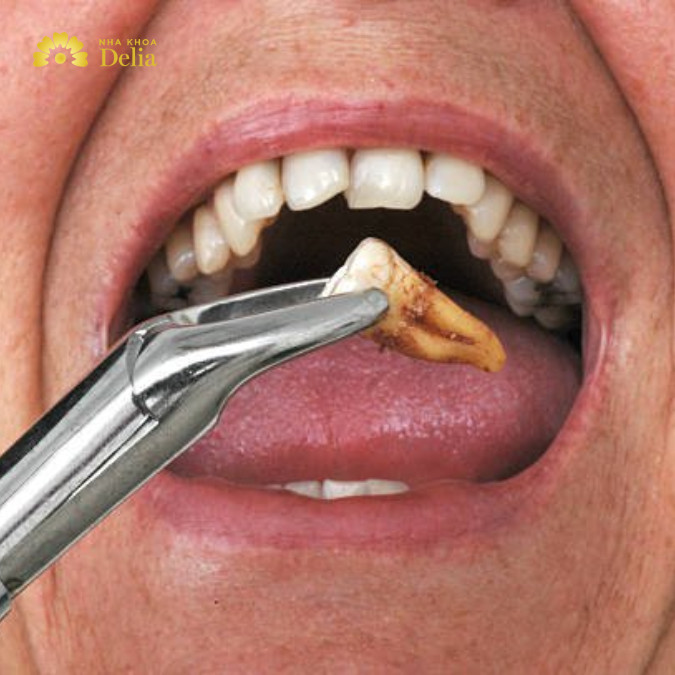 Răng sâu nặng không thể bảo tồn bằng các phương pháp như bọc sứ hay trám răng sẽ được chỉ định nhổ