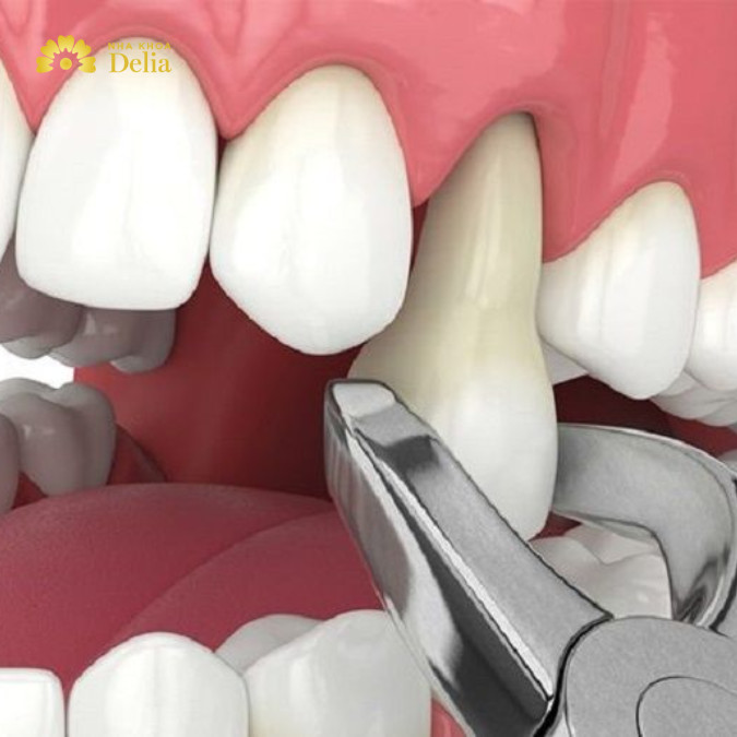 Theo bác sĩ Duy, nhổ răng số 4 không hề nguy hiểm nếu được thực hiện với bác sĩ có kinh nghiệm