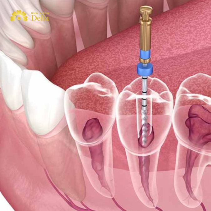 Điều trị tủy răng hay còn gọi là lấy tủy, là biện pháp cần thiết khi quá trình sâu răng đã lan đến tủy răng