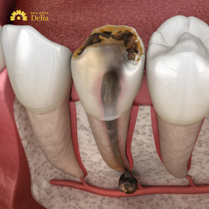 Răng hư tủy nên điều trị hay nhổ răng? - Giải pháp nào tốt
