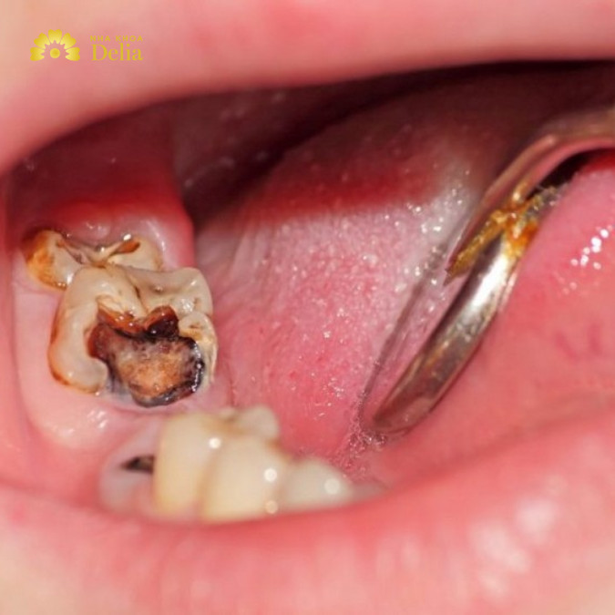 Răng hư tủy là tình trạng tủy răng bị tổn thương một phần hoặc đã bị chết tủy