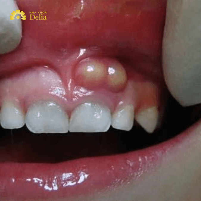 Nướu bị sưng và xuất hiện mủ là dấu hiệu của tình trạng hư tủy