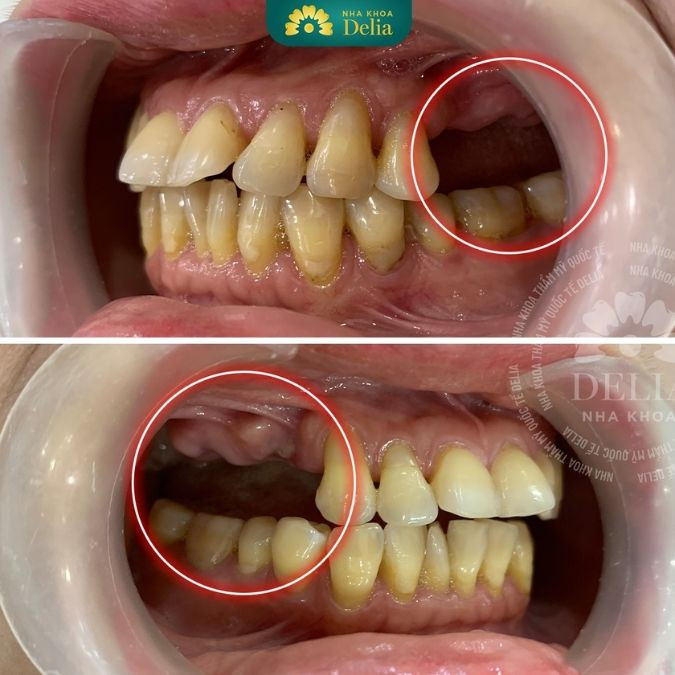 Răng hư tủy không điều trị sẽ có nguy cơ mất răng vĩnh viễn