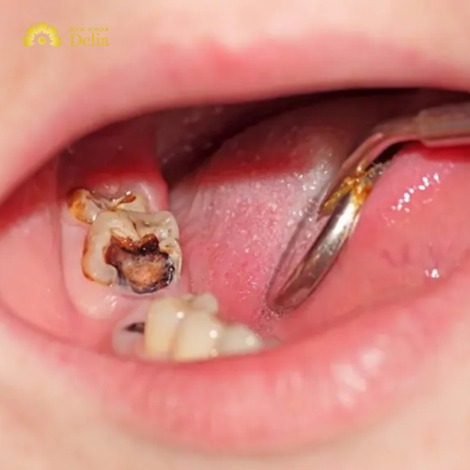 Răng sâu bị lung lay là tình trạng răng sâu nặng, cần được can thiệp sớm