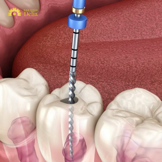 Răng sau khi lấy tủy sẽ không còn mạch máu để nuôi dưỡng nữa và trở thành răng chết
