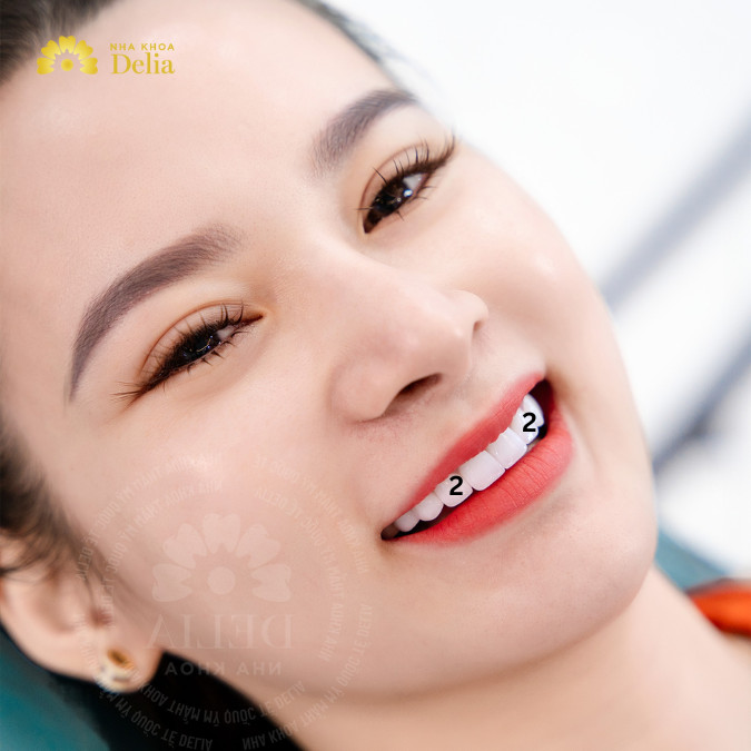 Răng số 2 còn gọi là răng cửa bên, là chiếc răng cửa nằm bên cạnh răng số 1 (răng cửa giữa) trên cung hàm
