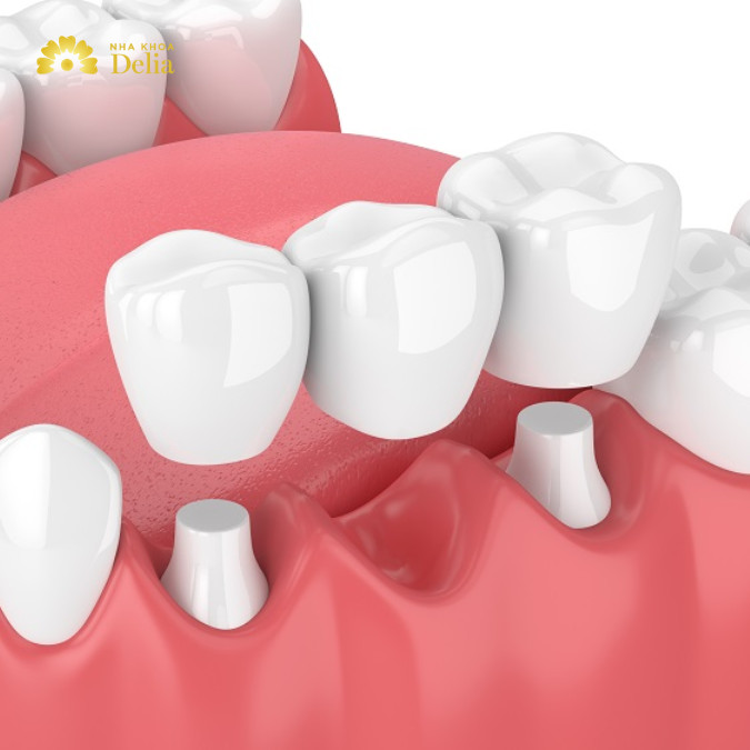 Răng số 1 và số 3 cần mài nhỏ để chụp mão sứ lên làm cầu răng