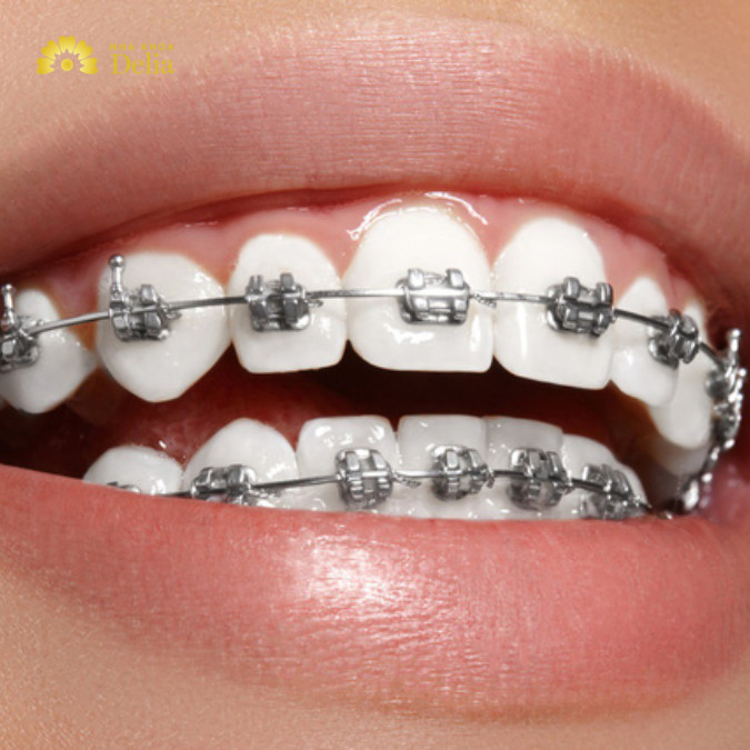 Mất răng số 2 nếu tạo khoảng trống không quá lớn thì hoàn toàn có thể niềng răng