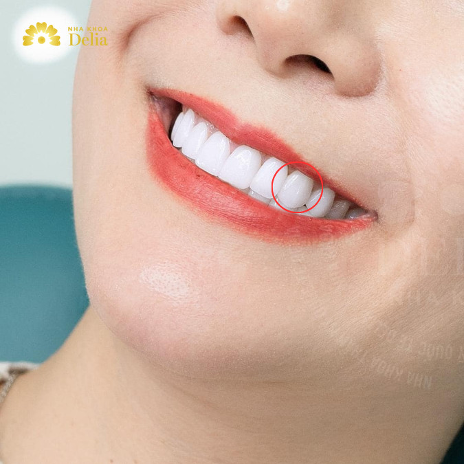 Răng số 3, thường được biết đến với tên gọi là răng nanh, là một trong những răng đặc trưng nhất trong cung hàm