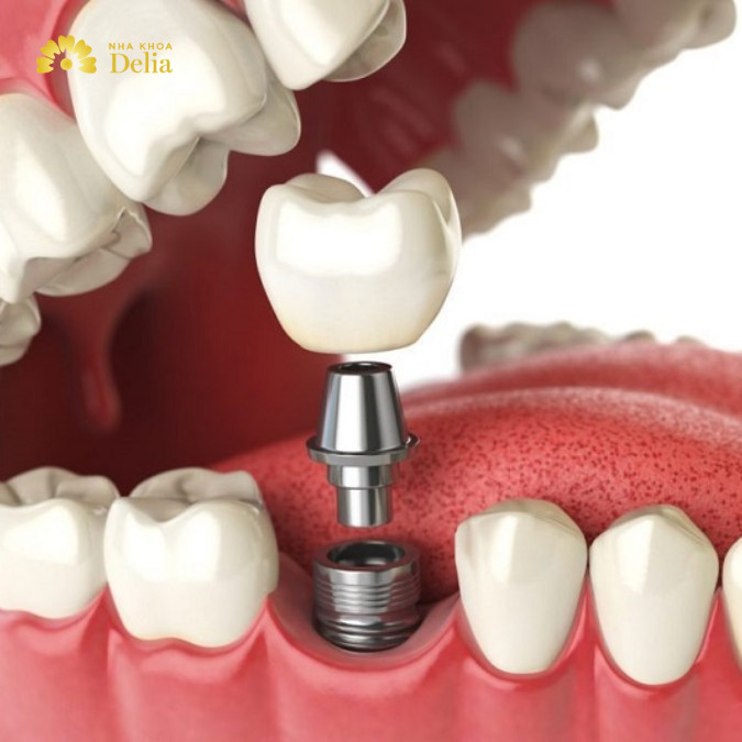 Cấu trúc răng Implant tương tự như cấu trúc của một răng thật