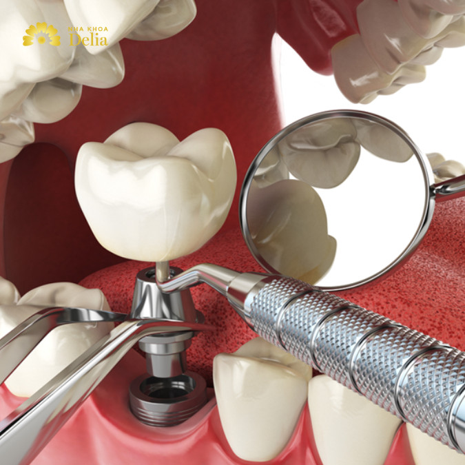 Răng số 6 bị mất phải phục hồi càng sớm càng tốt với phương pháp trồng răng Implant