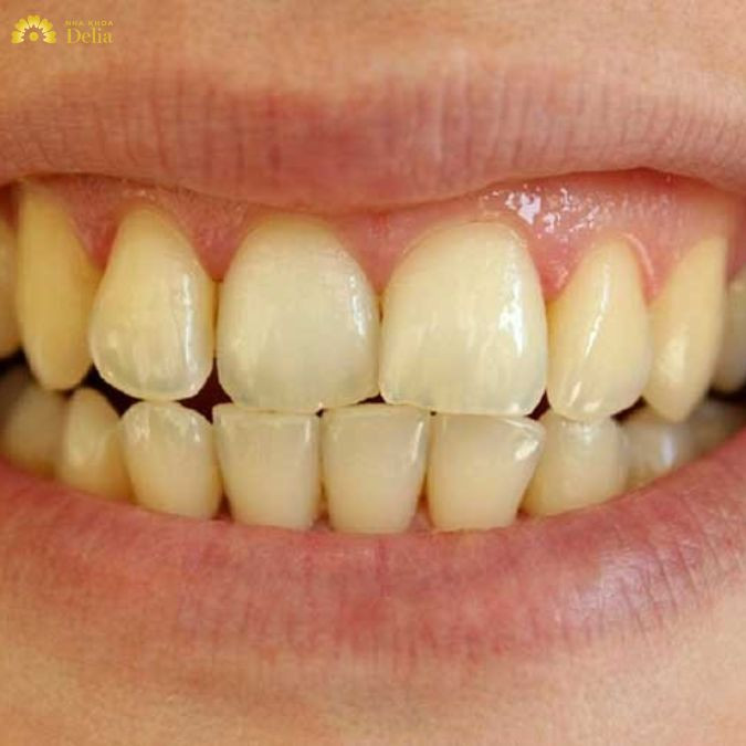 Trong trường hợp bạn tẩy trắng răng ở nha khoa thiếu uy tín thì chắc chắn răng sẽ nhanh chóng vàng trở lại