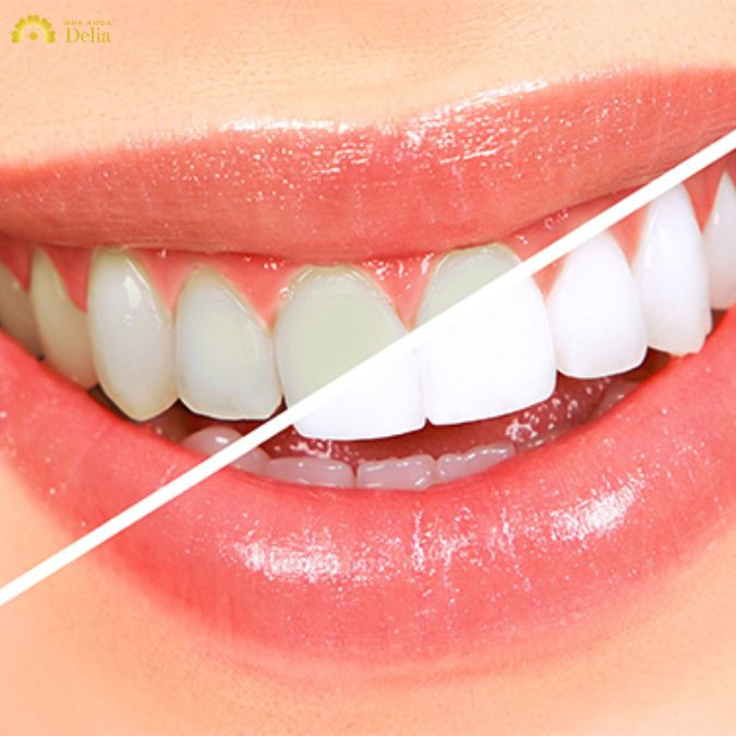 Tình trạng răng ố vàng trở lại sau khi tẩy trắng răng sẽ khác nhau ở mỗi người