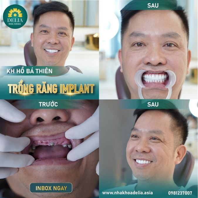 Anh Hồ Bá Thiên trước và sau khi đến với nha khoa Delia để trồng răng toàn hàm