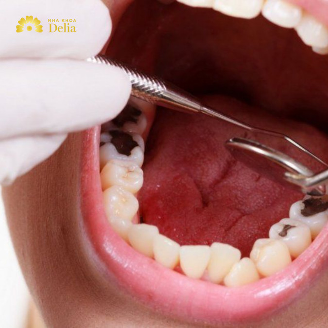 Teo tủy là tình trạng tủy răng bị thu nhỏ lại do tuổi tác hoặc do các tác nhân khác như chấn thương, nhiễm trùng, tia xạ...