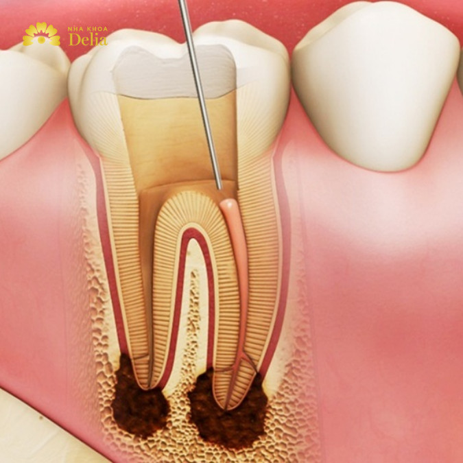 Viêm tủy răng là bệnh lý phổ biến nhất của tủy răng, thường do vi khuẩn xâm nhập qua lỗ sâu răng